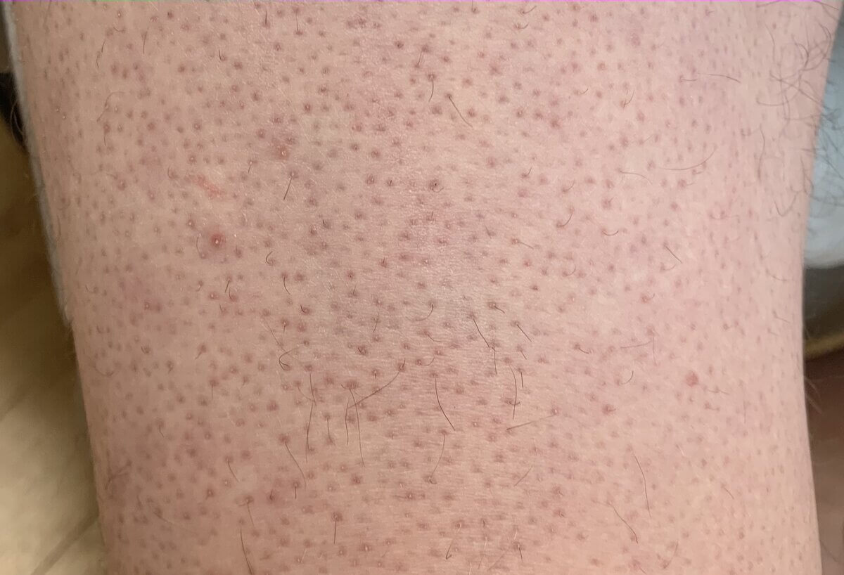 Keratosis Pilaris