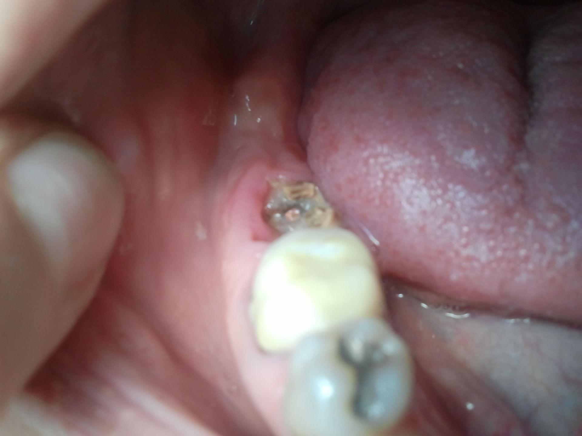 Corona molare caduta senza disturbi della paziente