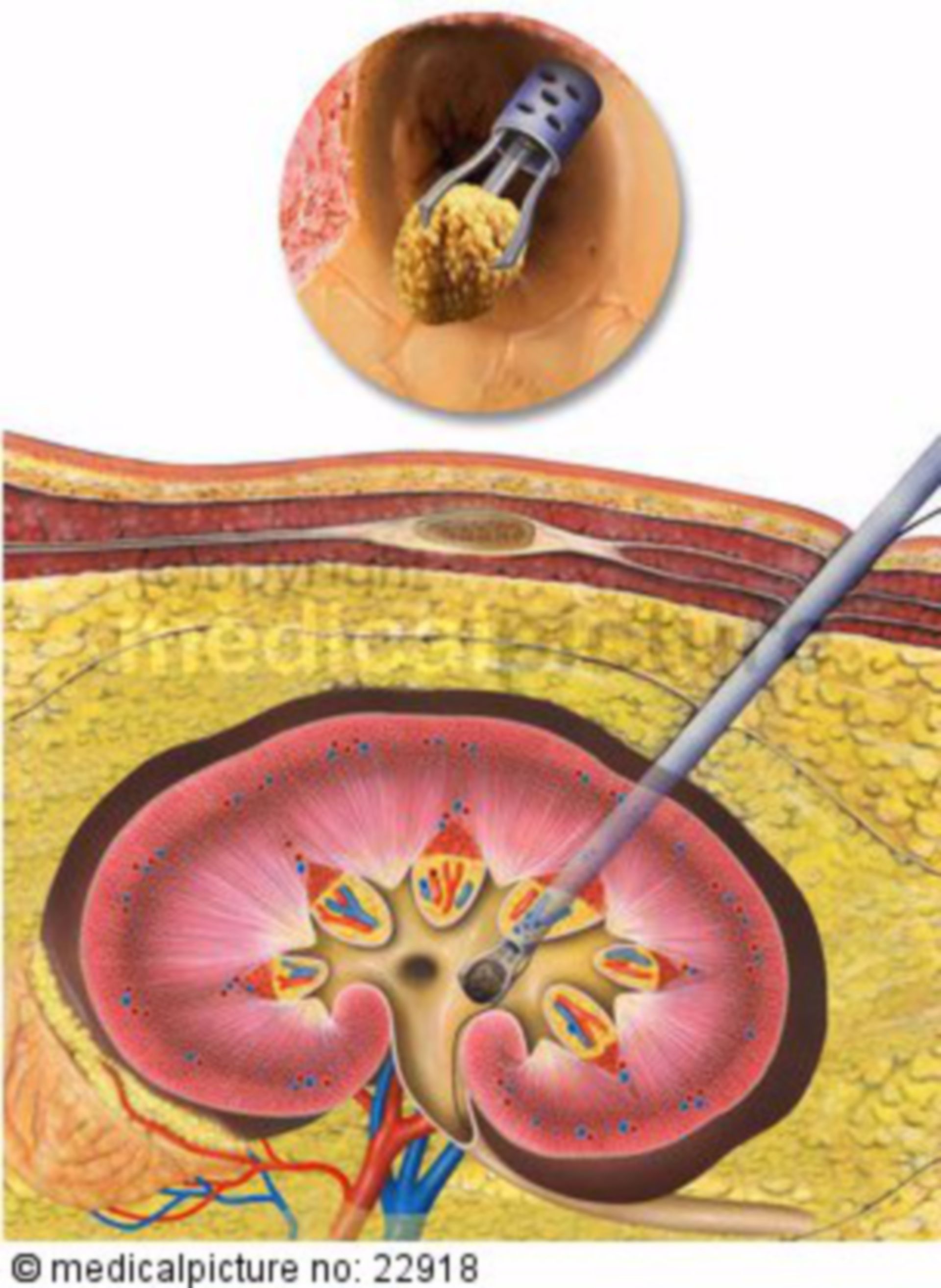 Renal biopsy due to kidney stones