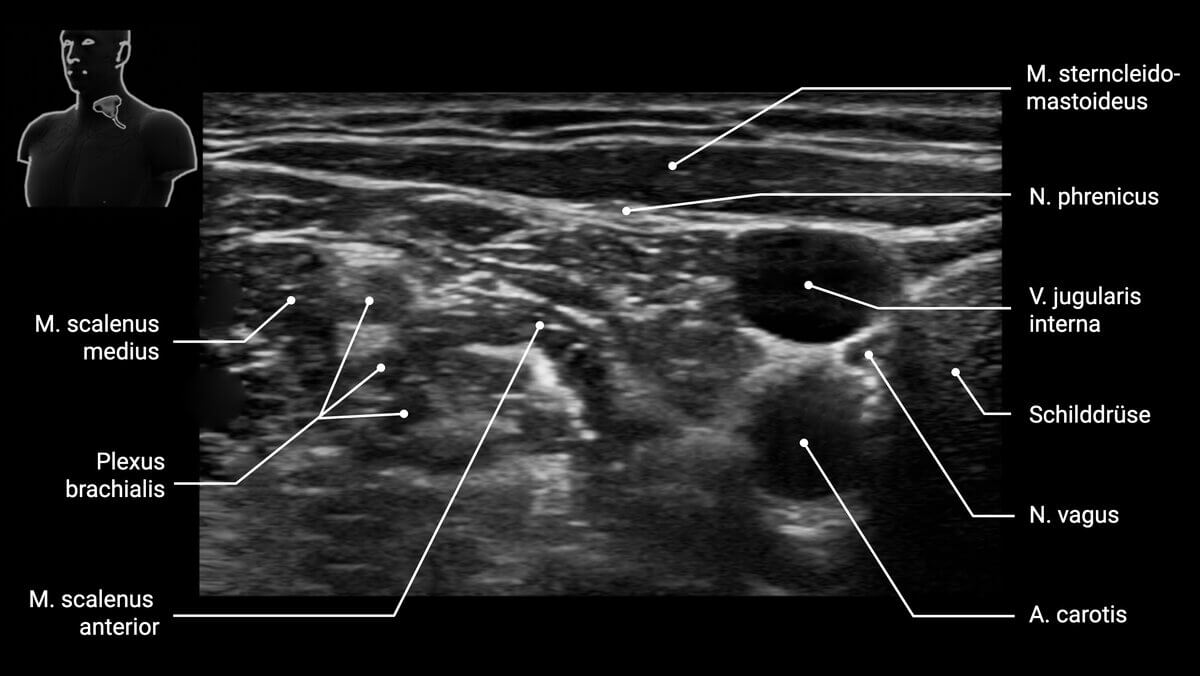 Sonographie des Halses
