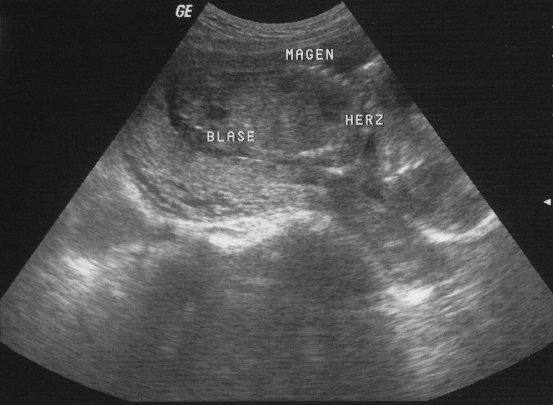 Ultrasound image - 18 weeks pregnant