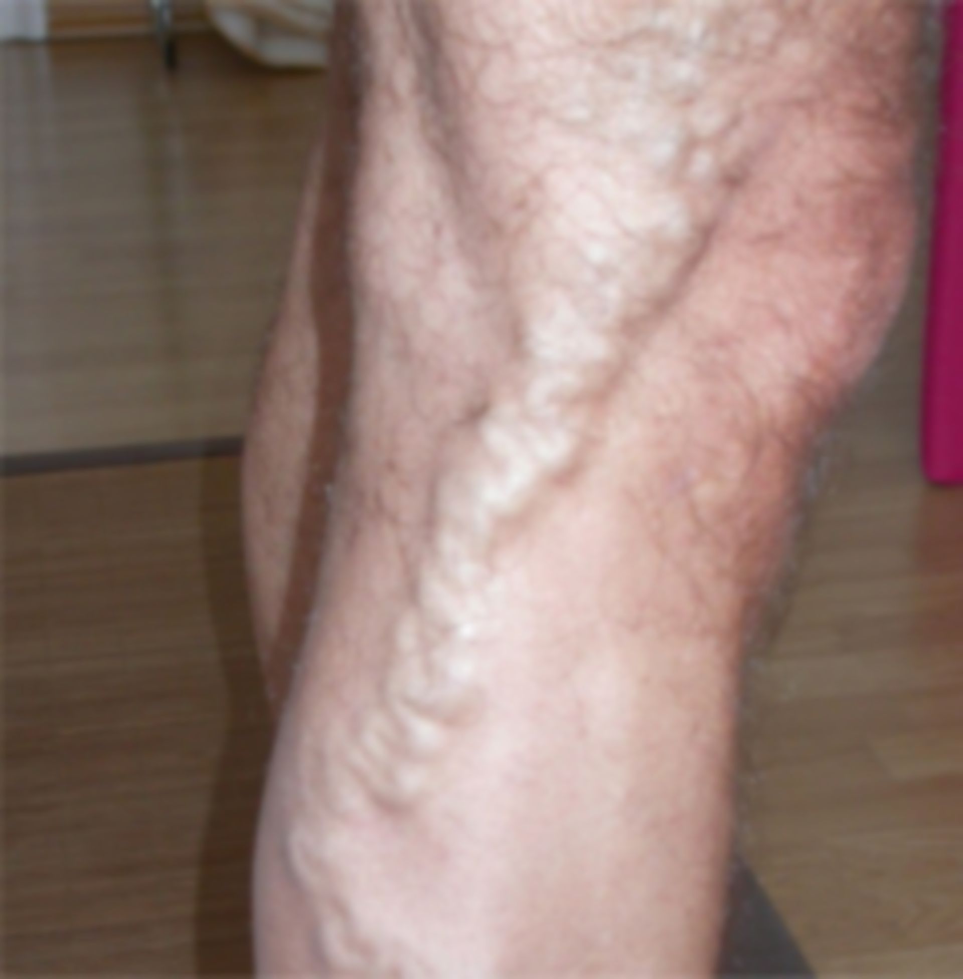 Varicose vein of the lateral accessory saphenous vein