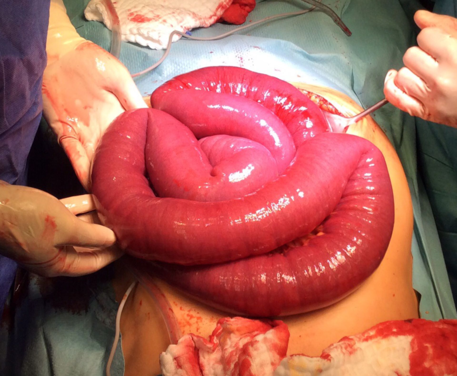 Ileus of the small intestine due to perforated appendicitis