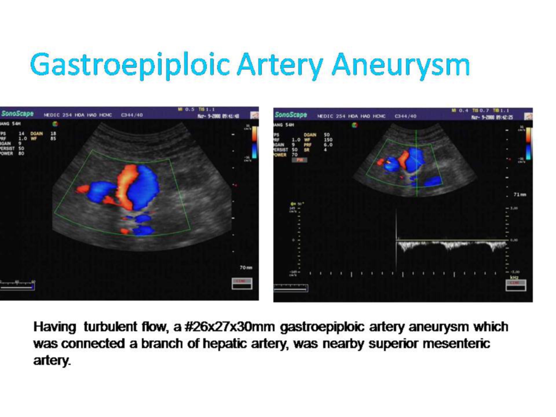 Aneurysma der Arteria gastroepiploica (1)