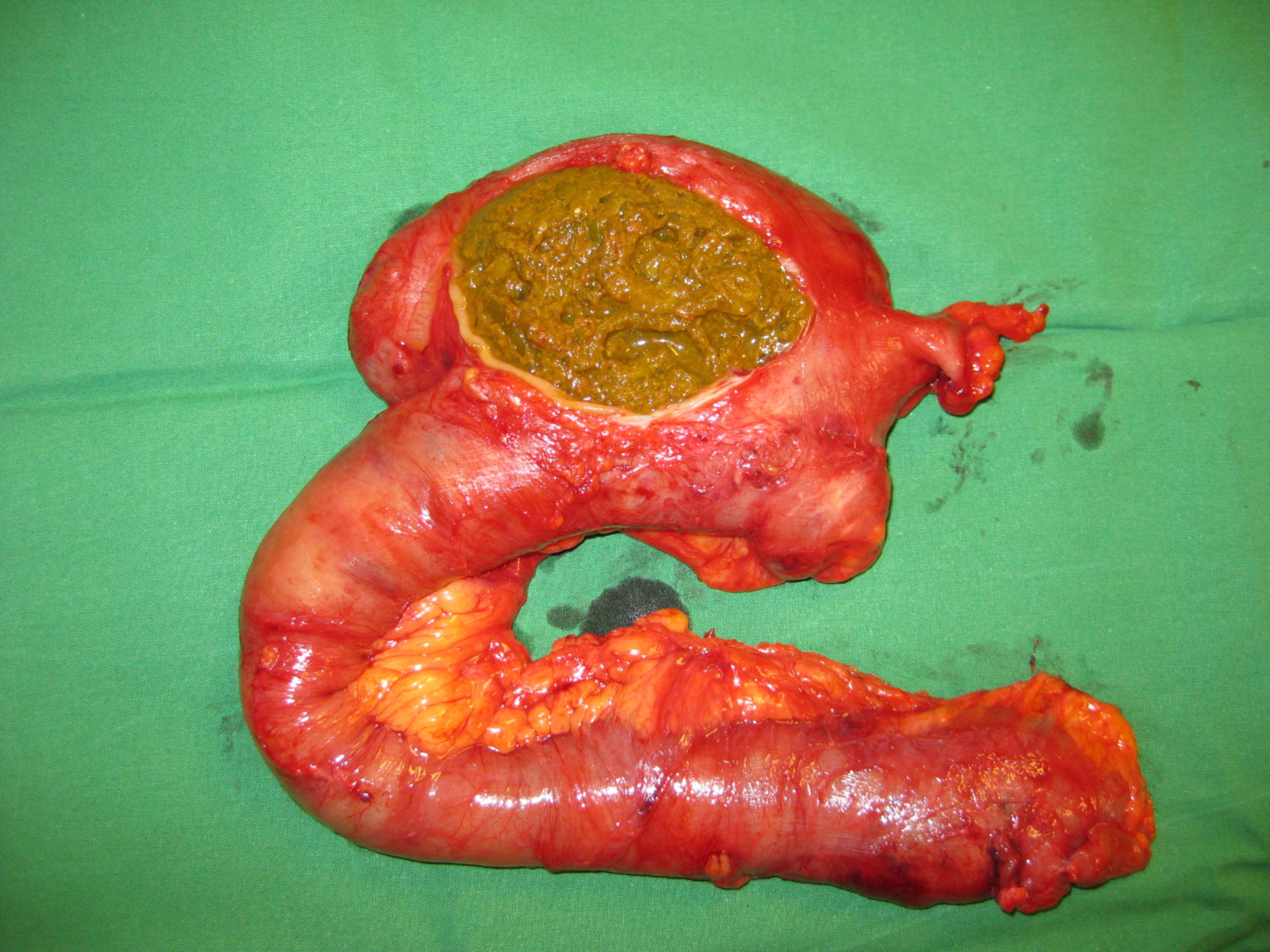La obstrucción del intestino debido a la cáscara de la fruta indigesta - fitobezoar
