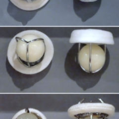 Valvuloplastie DocCheck Flexikon