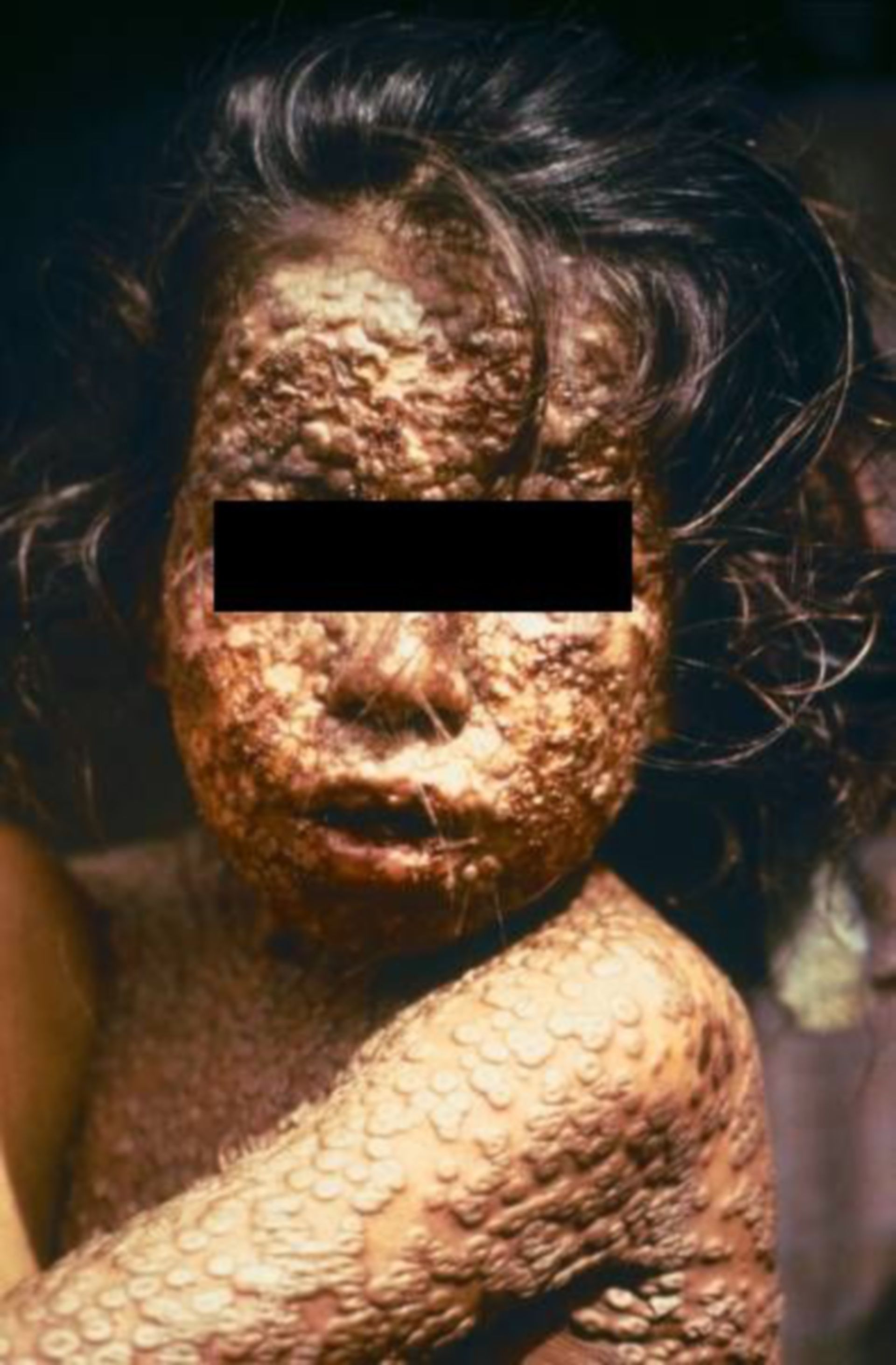 Ein mit Pocken infiziertes Kind (Bangladesh)