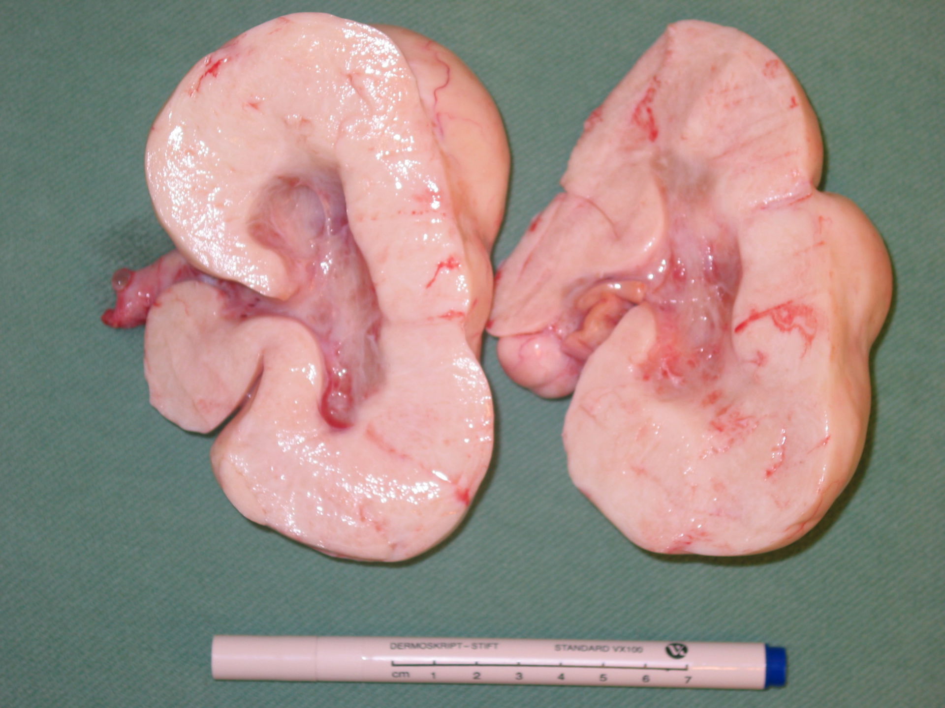 Granulosa-theca cell tumor of the ovary