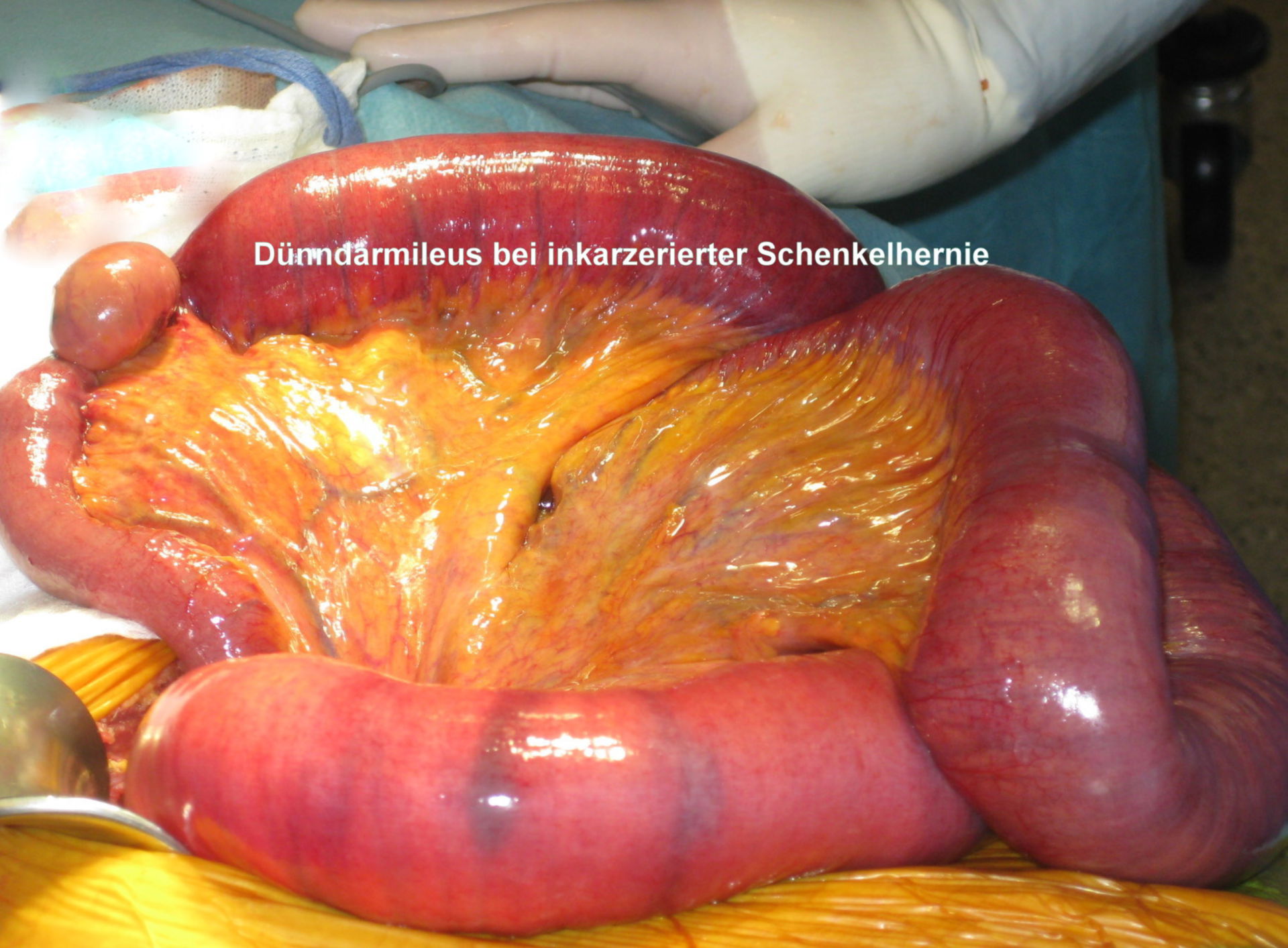 Small bowel obstruction upon incarcerated femoral hernia