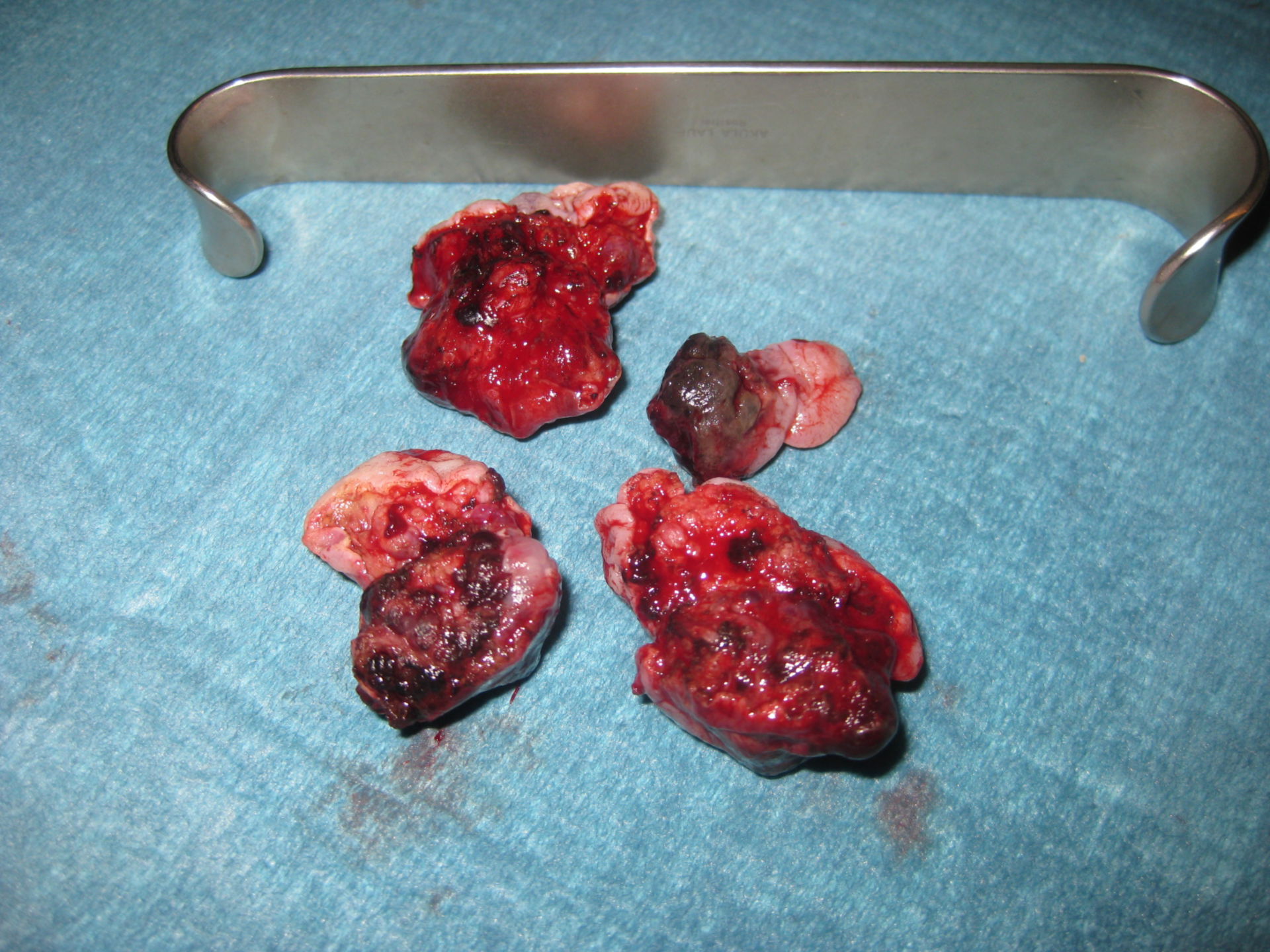 Resected hemorrhoids