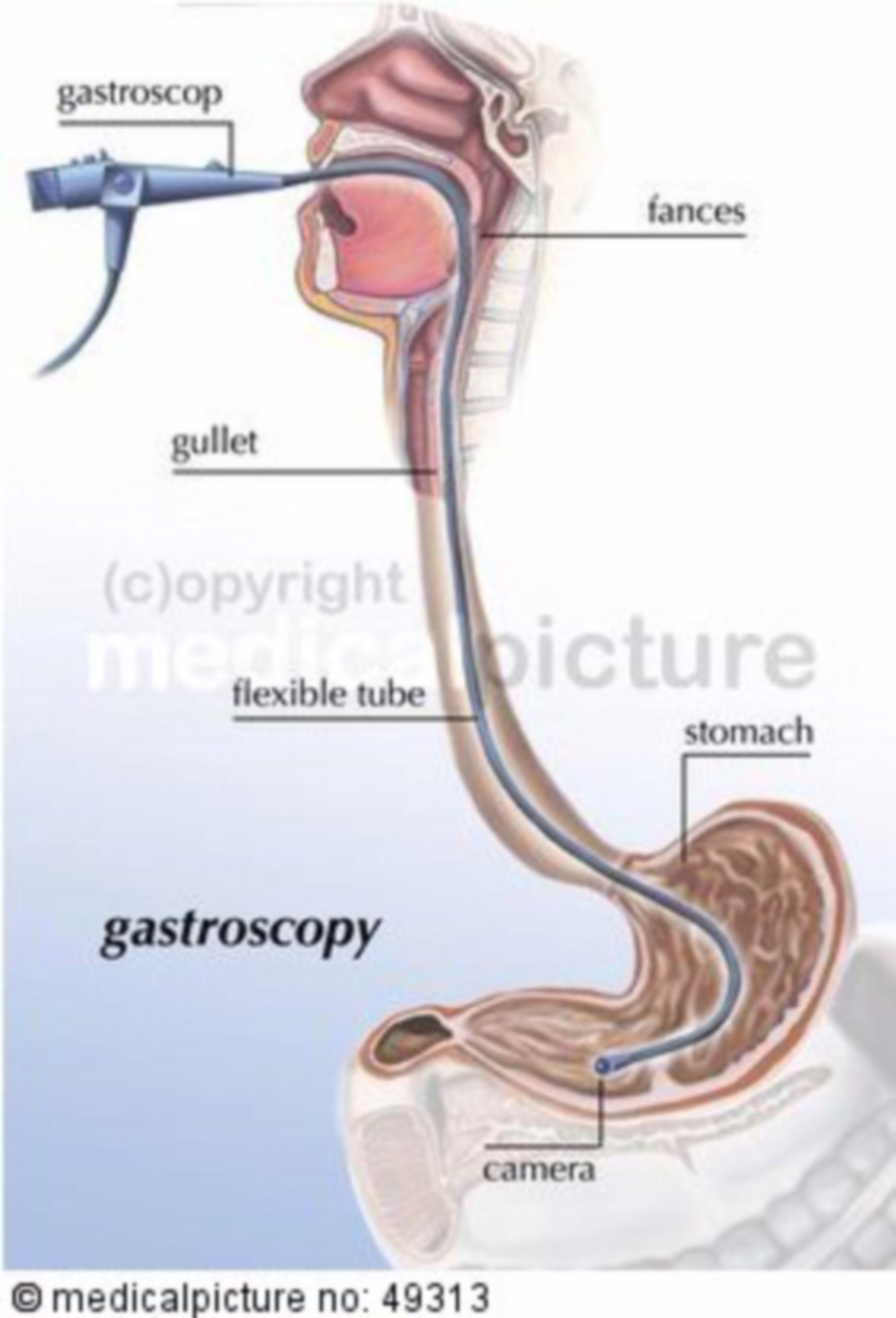 Magenspiegelung (Gastroskopie)