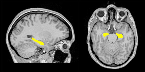 Lage das Hippokamus im menschlichen Gehirn: sagittale und axiale Ansicht (von links nach rechts) des Hippokampus (in gelb) in einer Magnetresonanztomographie-Aufnahme. © Neuropsychiarty and Brain Imaging Group, Basel