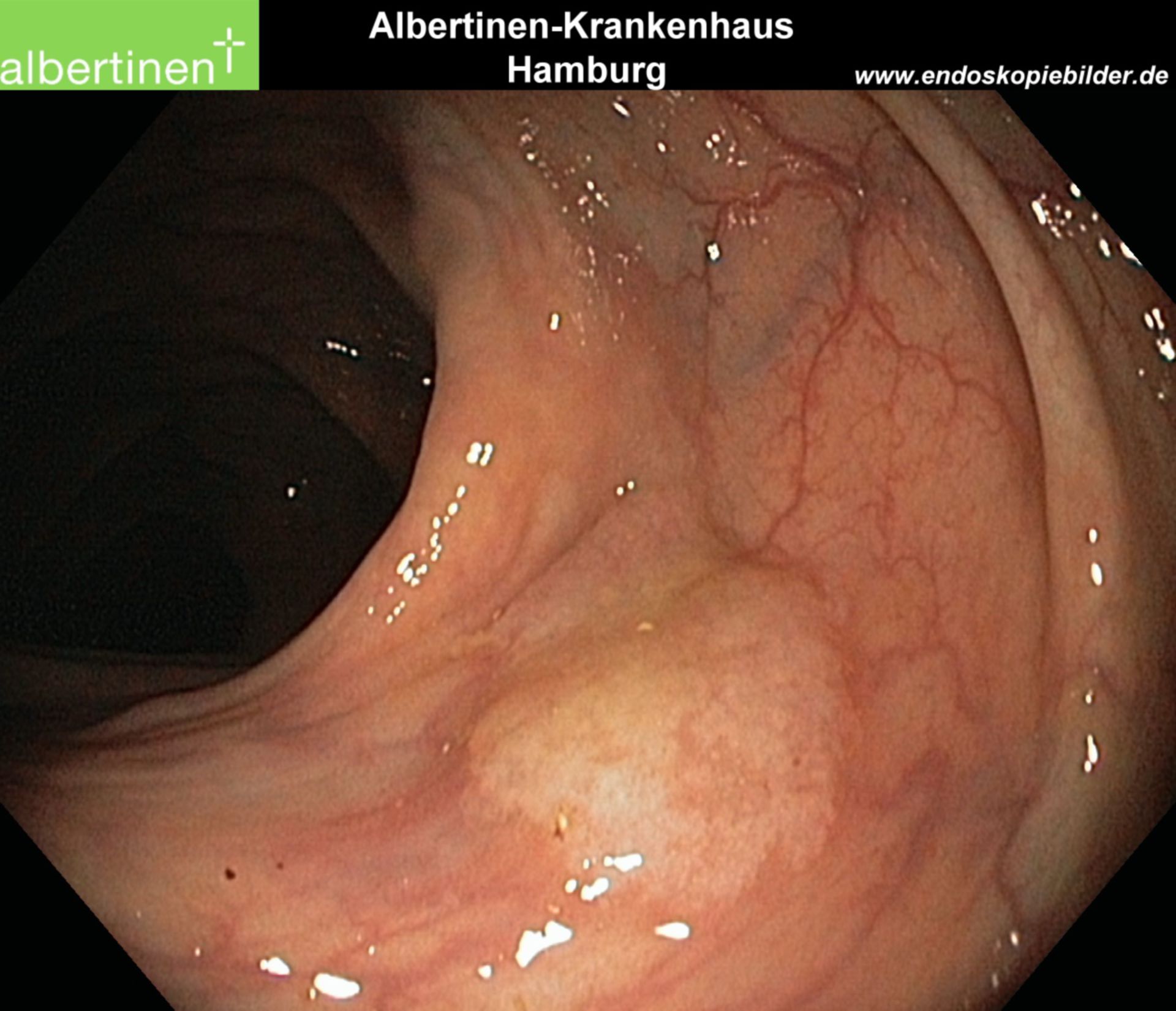 Serrated adenoma (endoscopy)