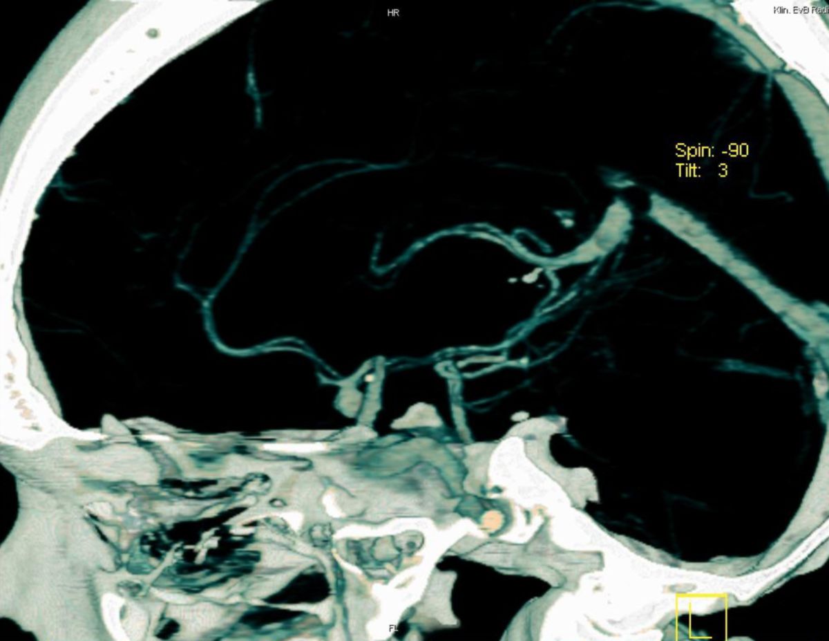 Aneurysma - CT-Angiographie, ReKo sagittal