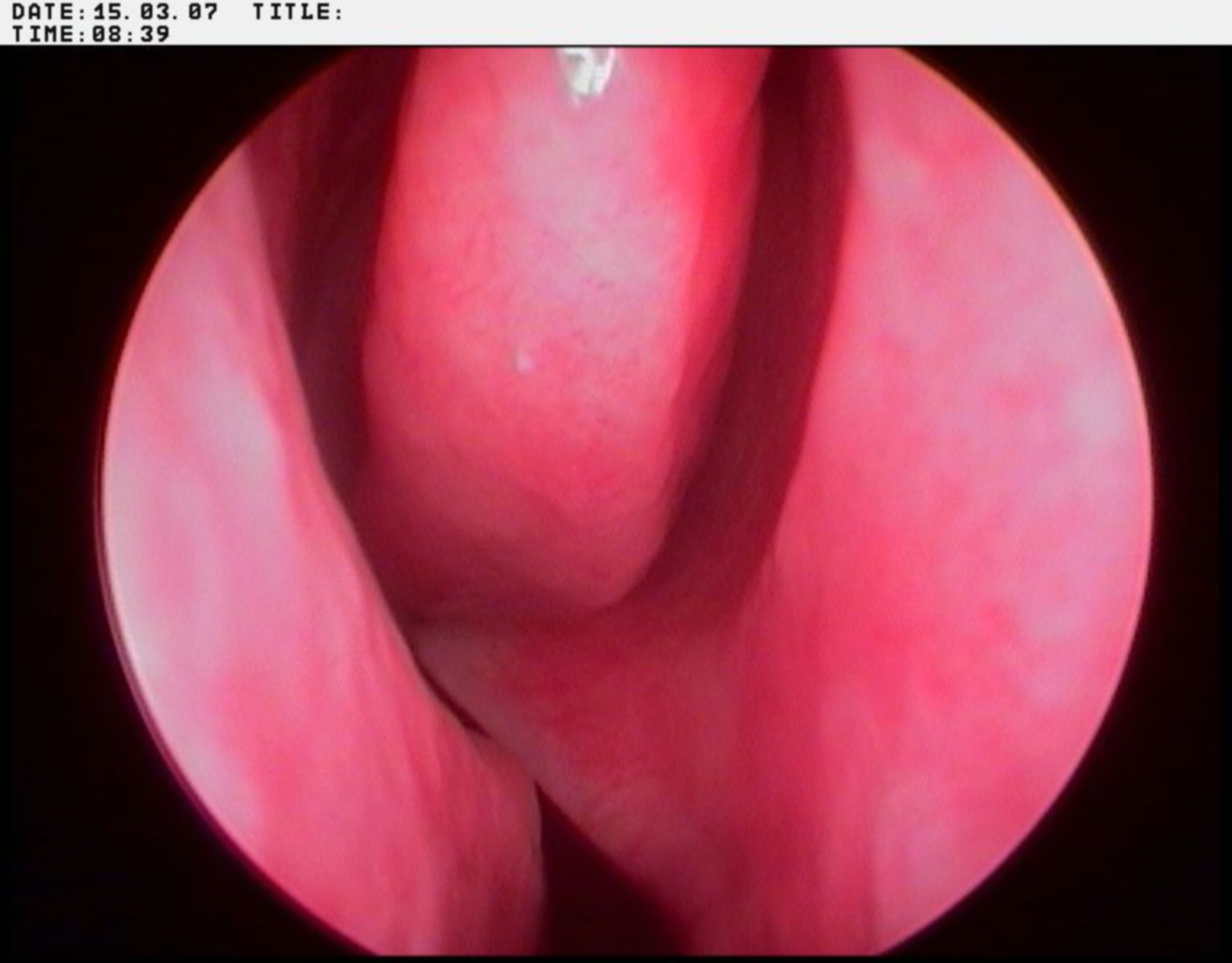 Difficult breathing due to nasal septum deviation