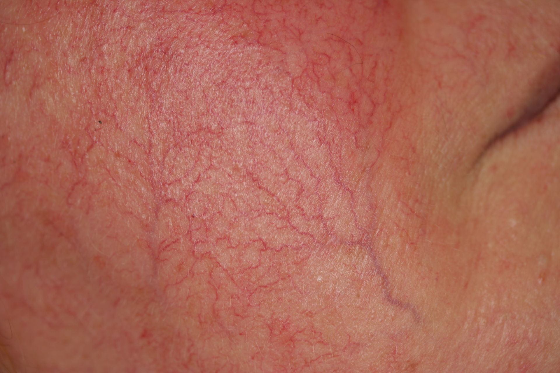 Telangiectasia DocCheck Telangiectasia DocCheck