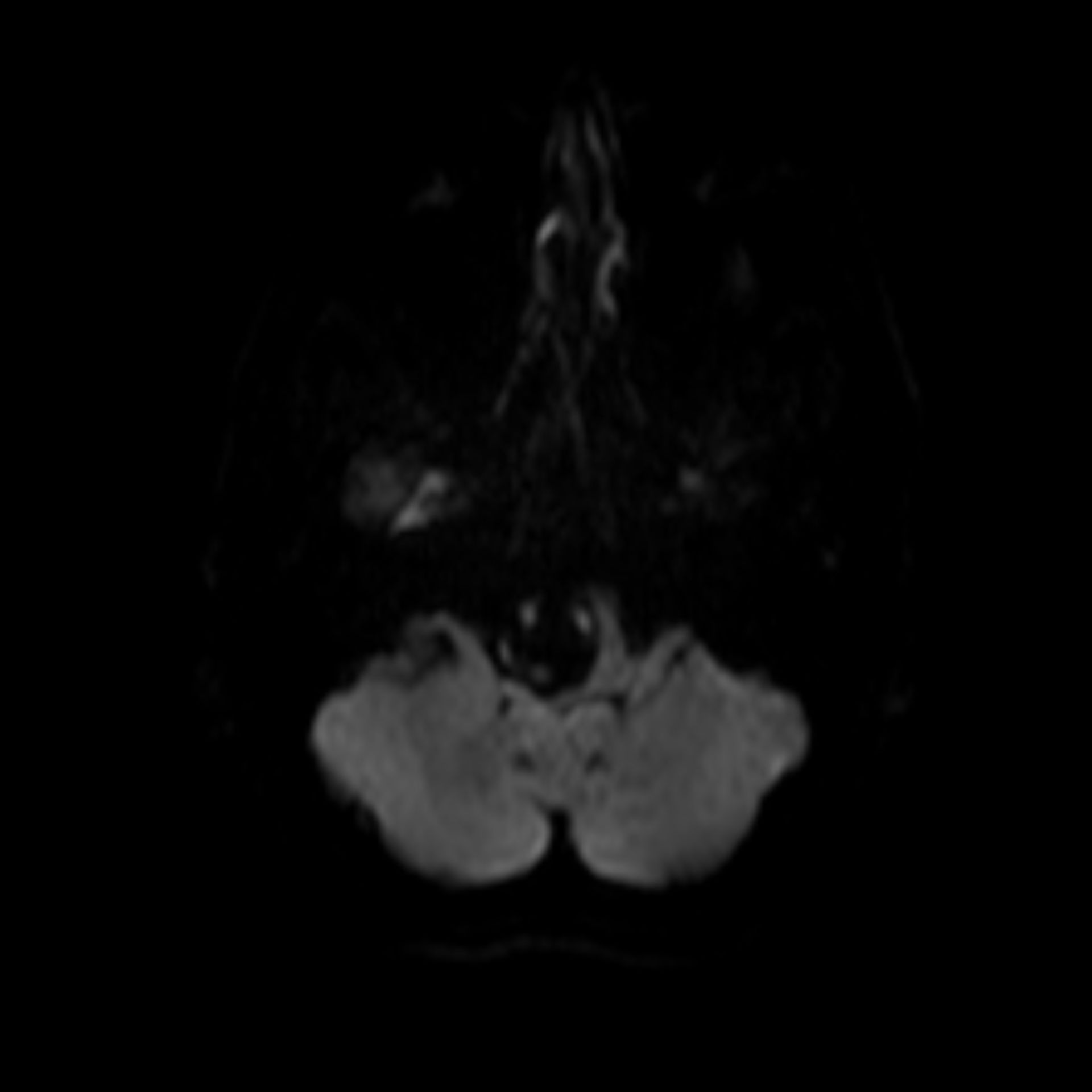 Riesenaneurysma der A. vertebralis (b_1000_diffusion00001)