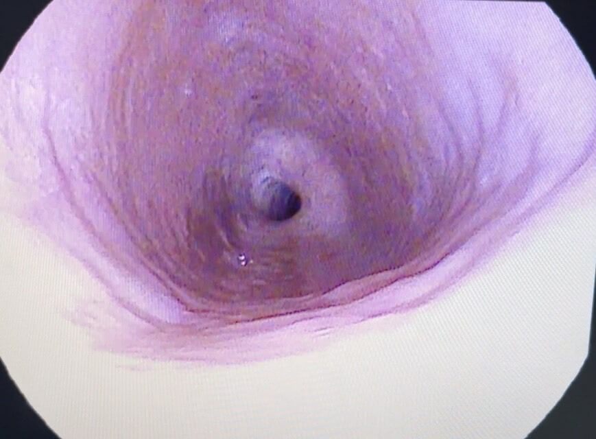 a_wide_esophagus_due_to_trapped_air._this_is_common_in_rcpd__original.jpg