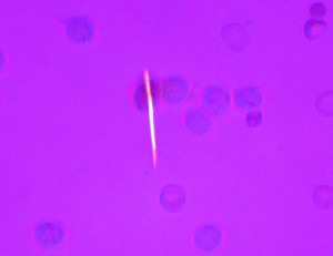 Uratkristalle in Gelenkflüssigkeit. Credit: Ed Uthman from Houston, TX, USA - Gout: monosodium urate crystals in joint fluid, CC BY 2.0.