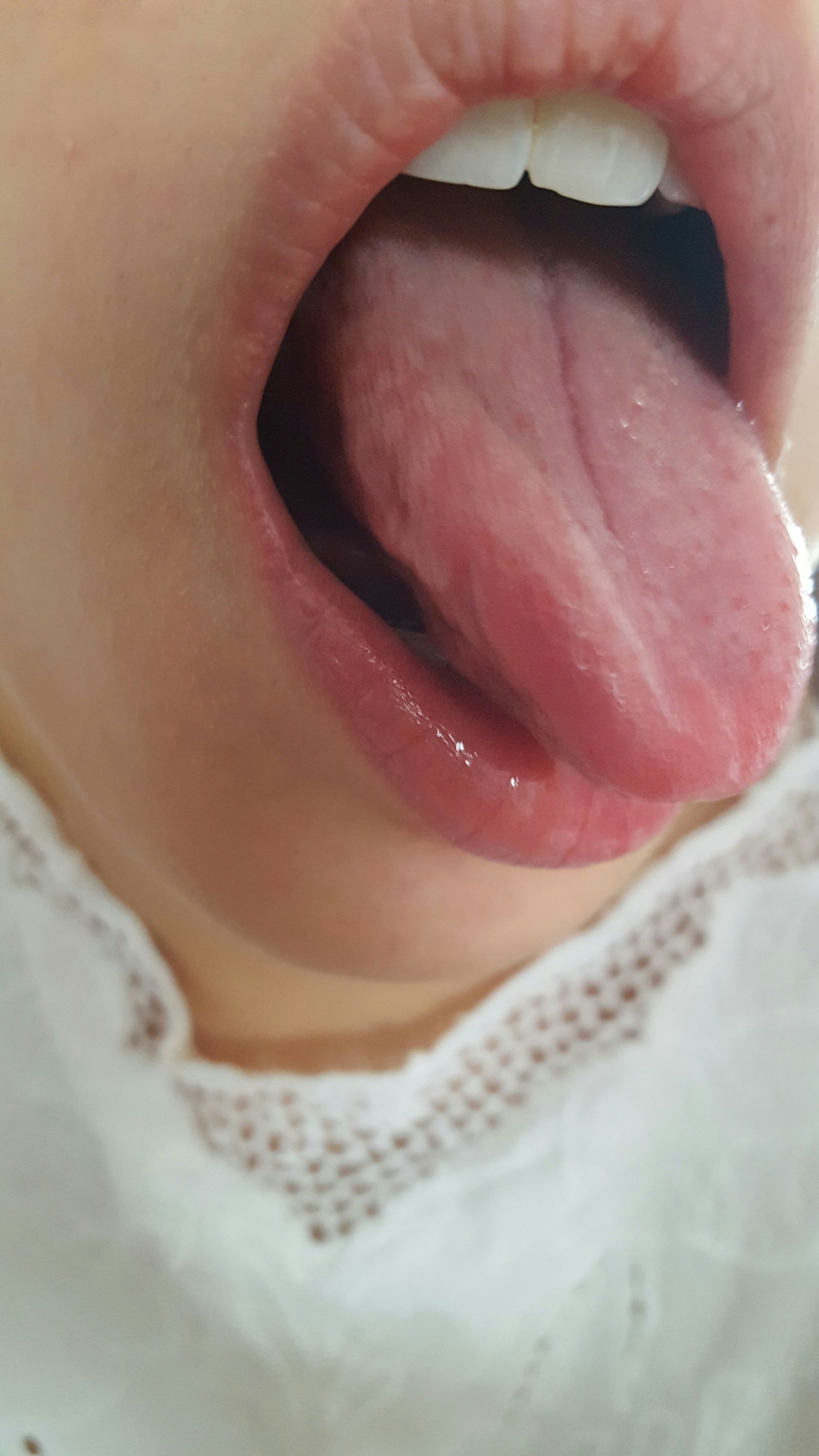Zunge Patientin