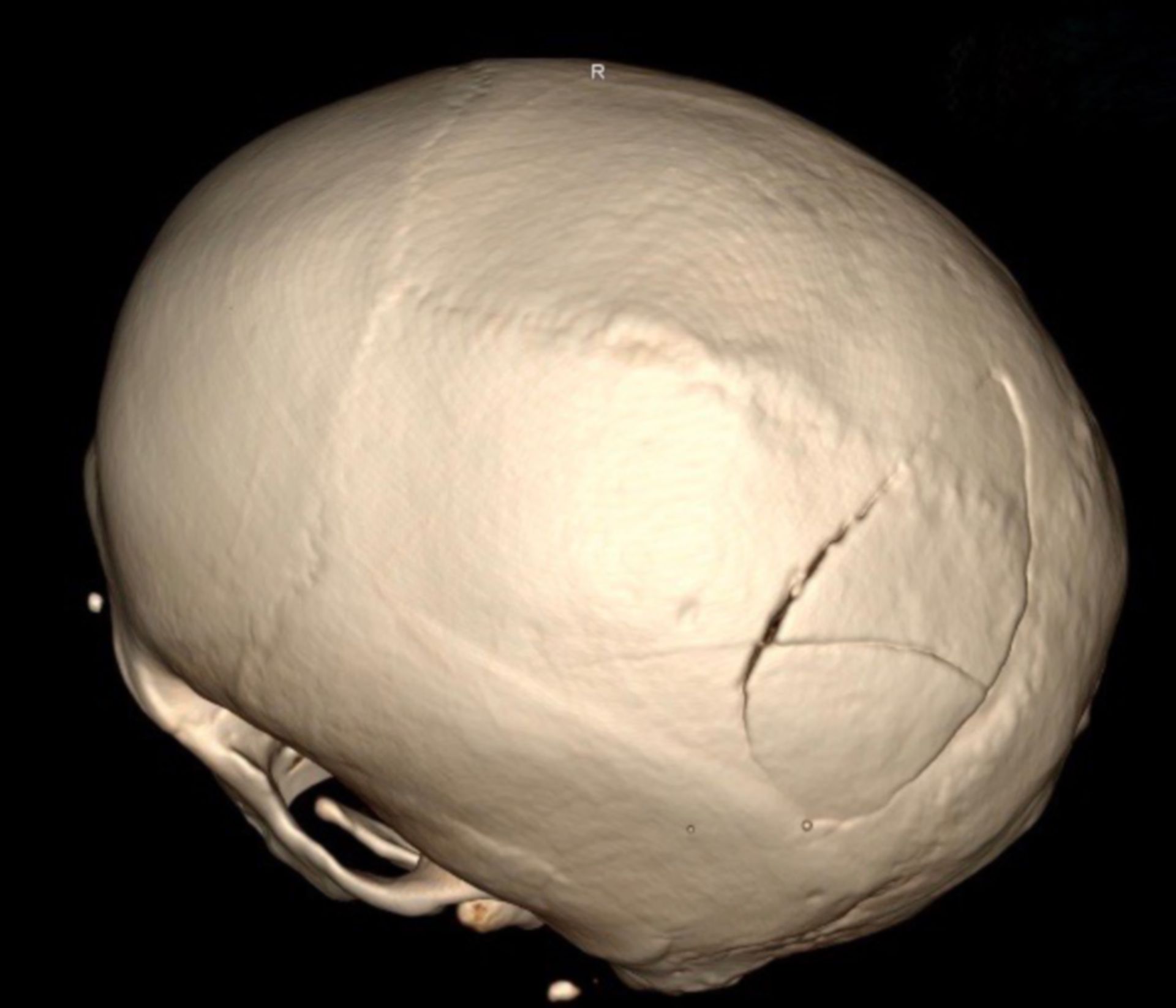 3D Rekonstruktion des knöchernen Schädels in der Ansicht von dorsal