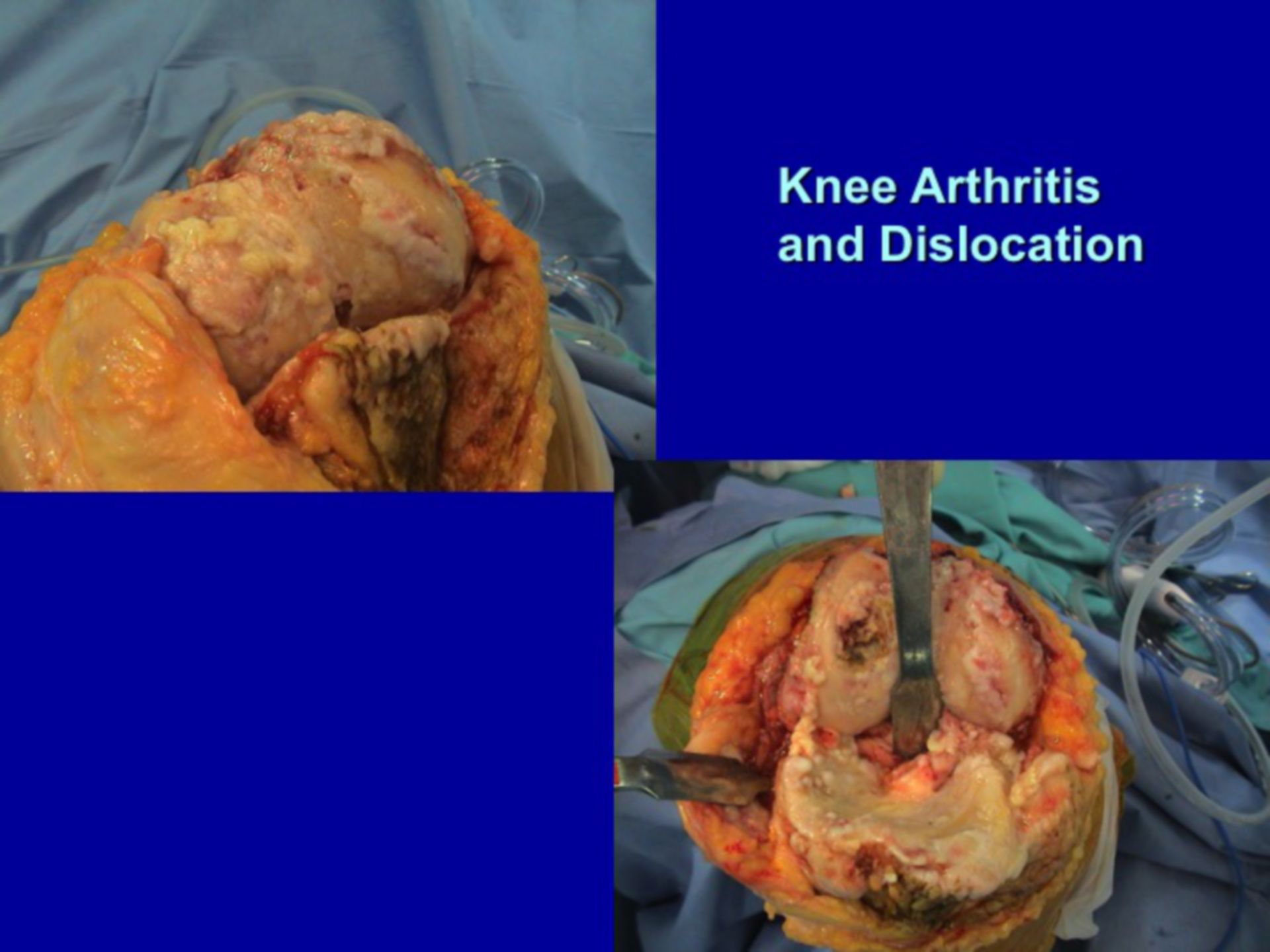 Arthritis Kniegelenk - Arthroplastik