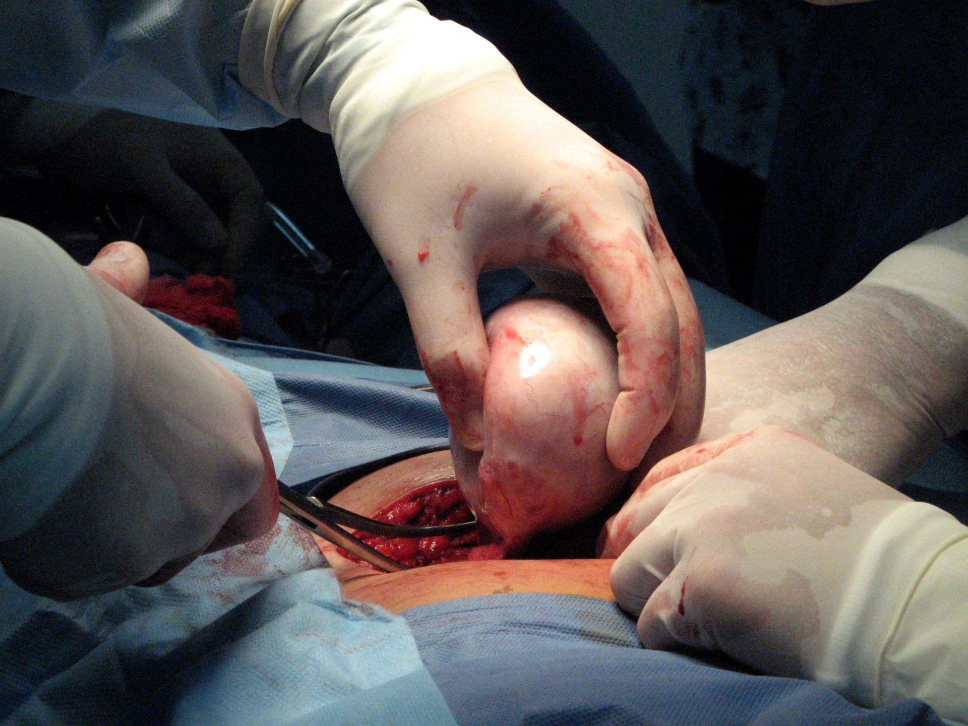 Intervento chirurgico di rimozione di un teratoma ovarico