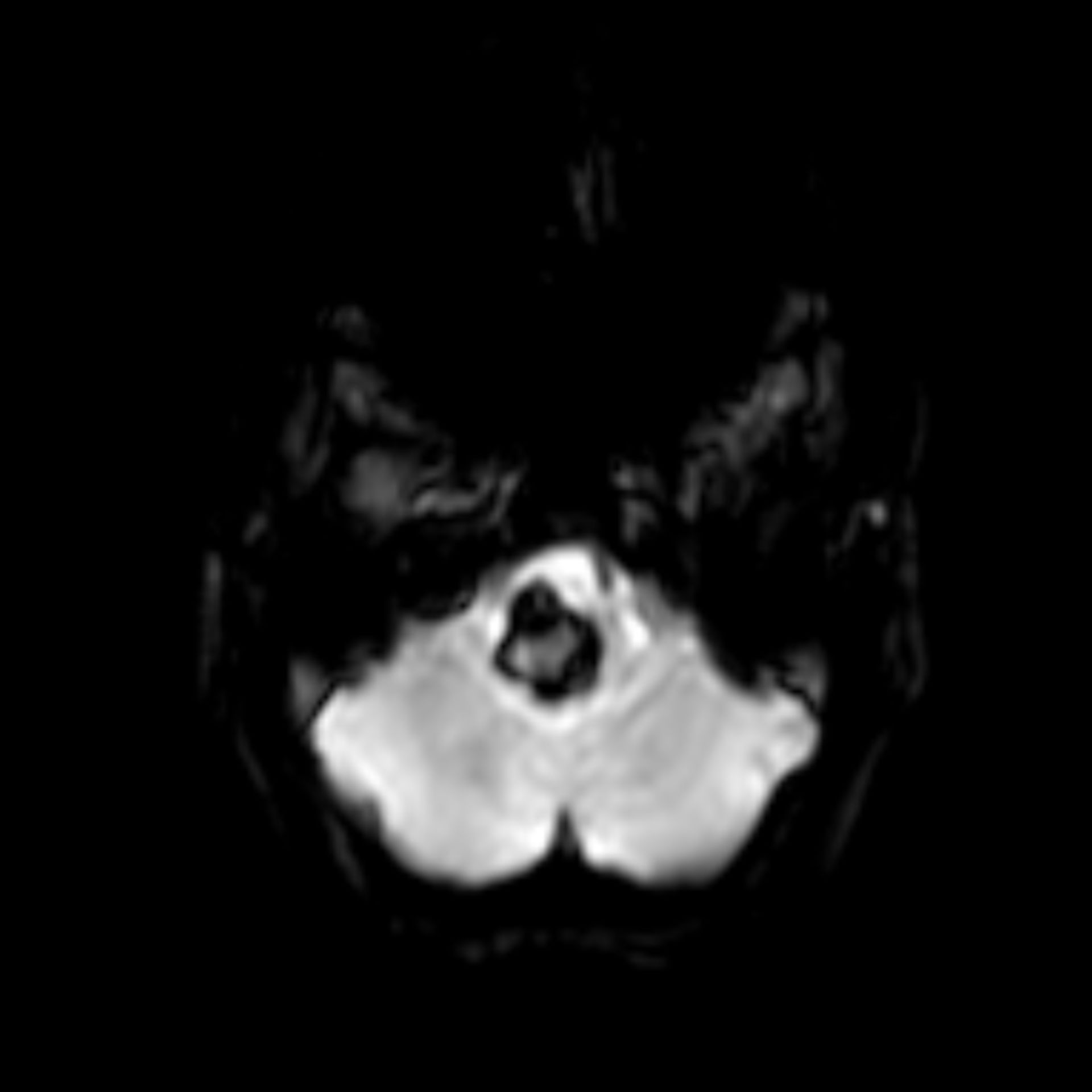 Riesenaneurysma der A. vertebralis (haemo_tra00001)