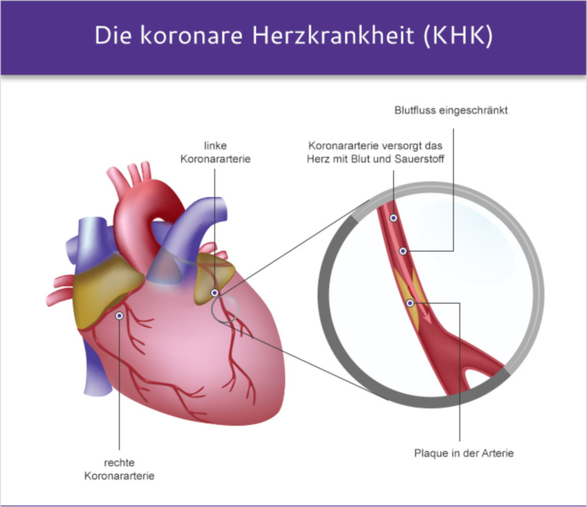 Koronare Herzkrankheit KHK DocCheck