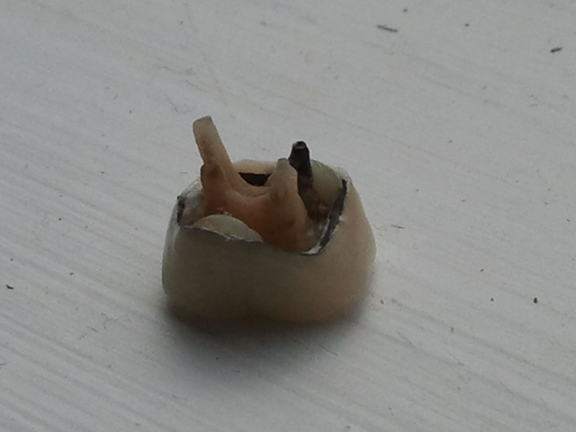 Zahnkrone herausgefallen von Seite