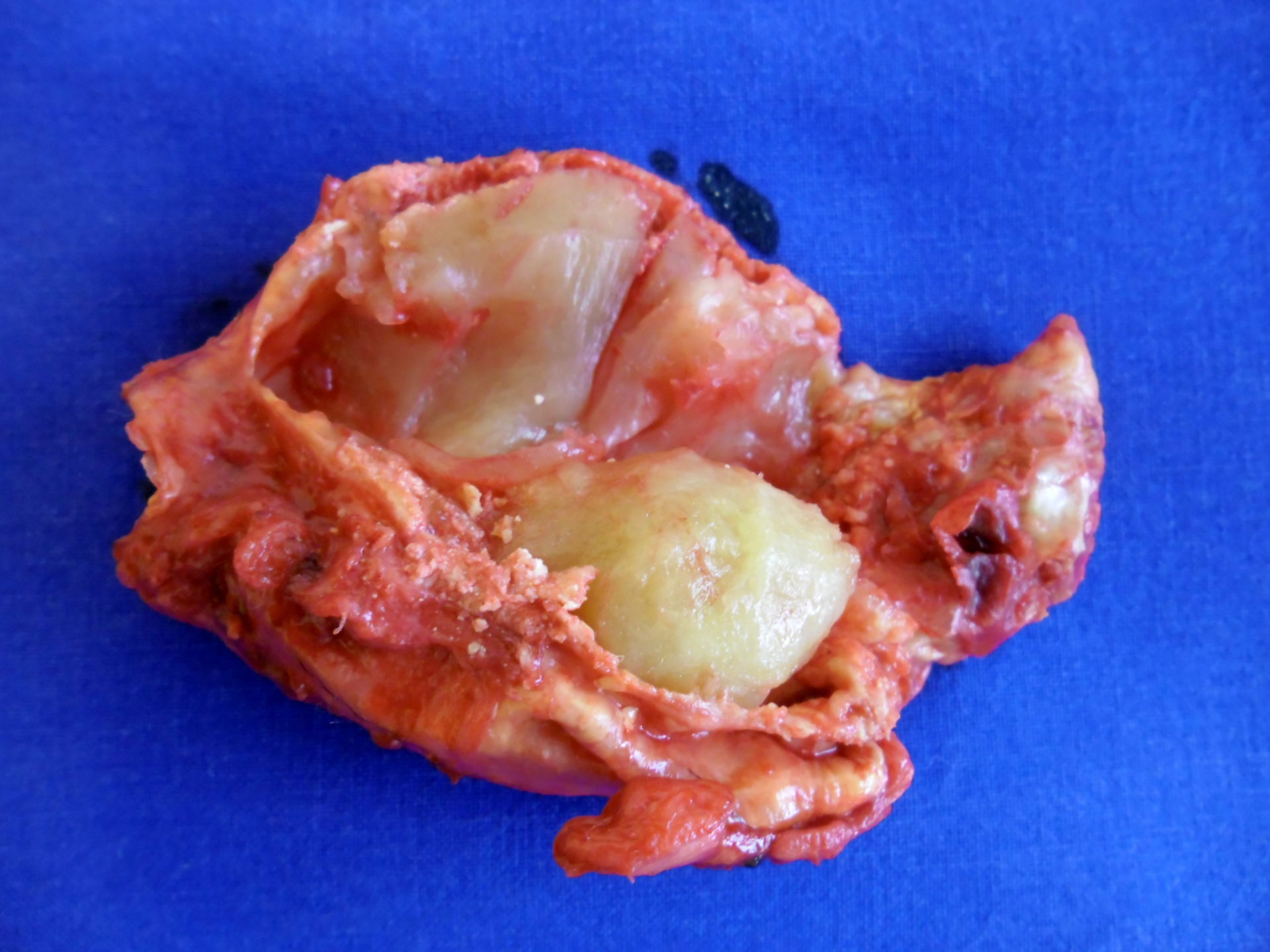 Plaque of the carotid artery