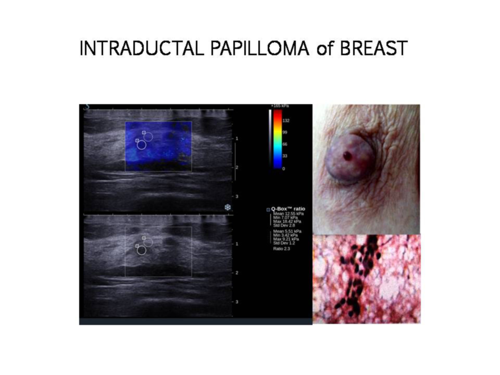 INTRADUCTAL PAPILLOMA of BREAST