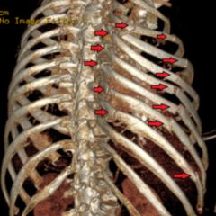 Instabiler Thorax - DocCheck Flexikon