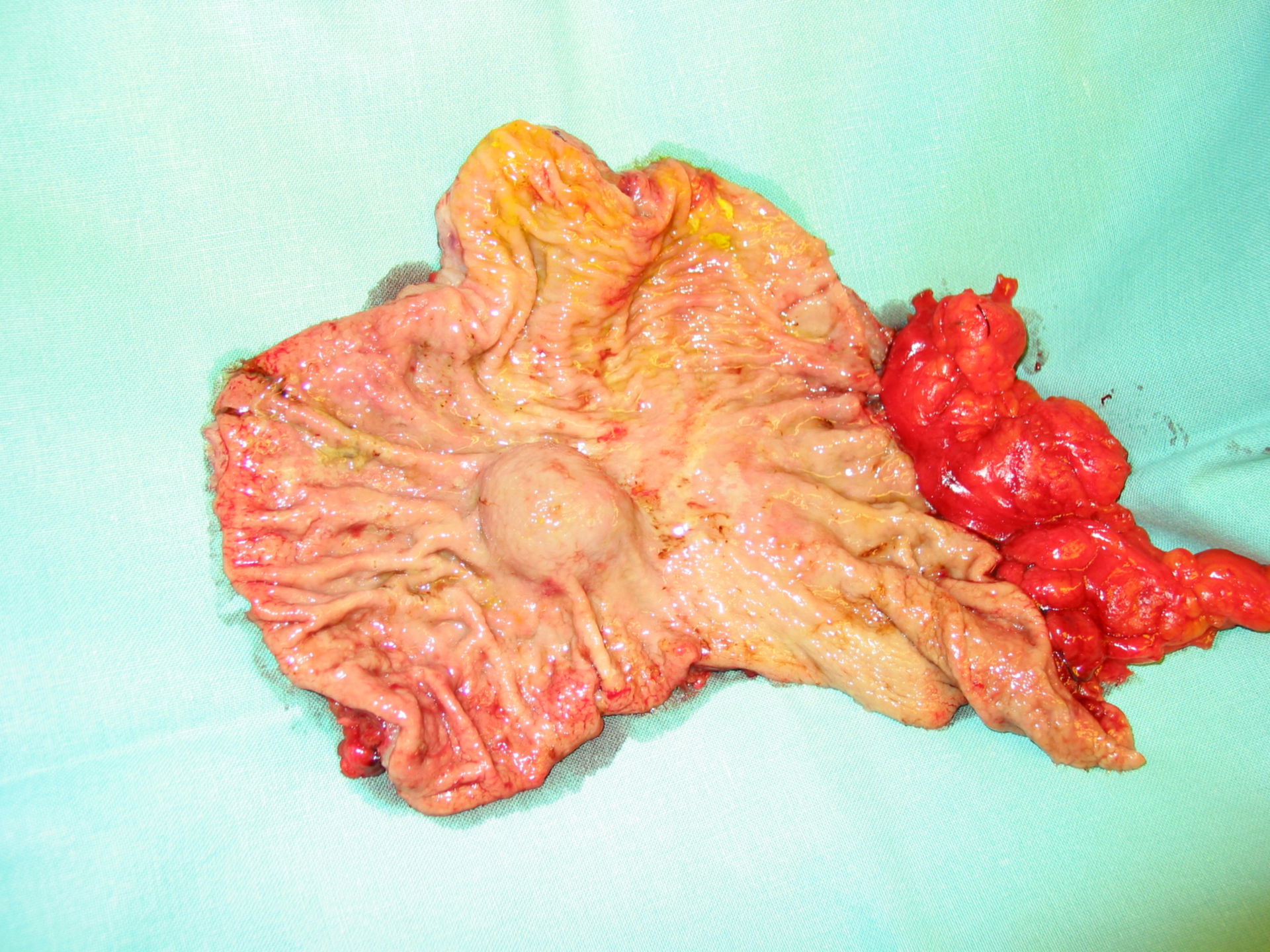 gastrointestinal stromal tumor (GIST)