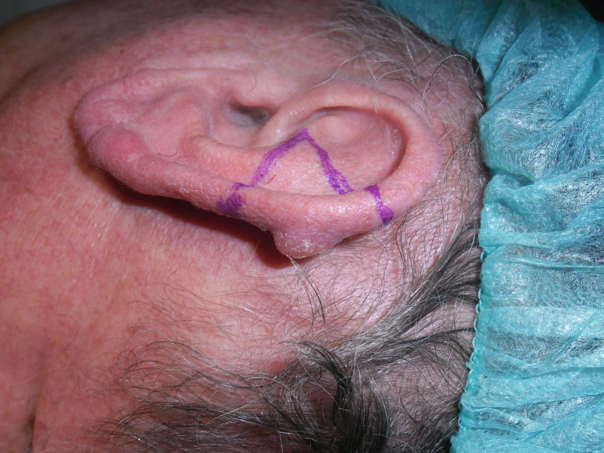 Carcinoma basocelular de la concha de la oreja linea de resección