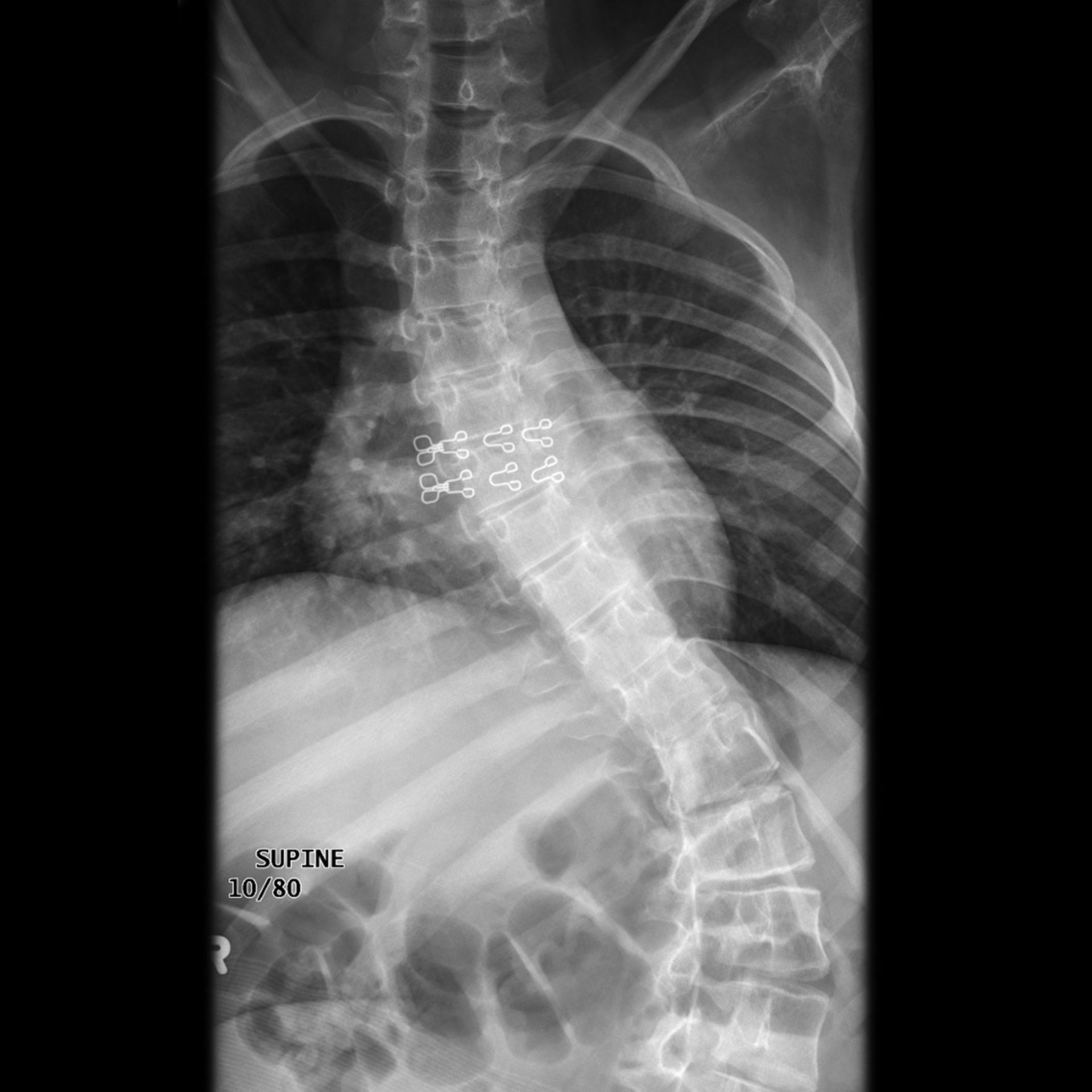 Spinale Muskelatrophie Typ II mit Skoliose (Röntgen)