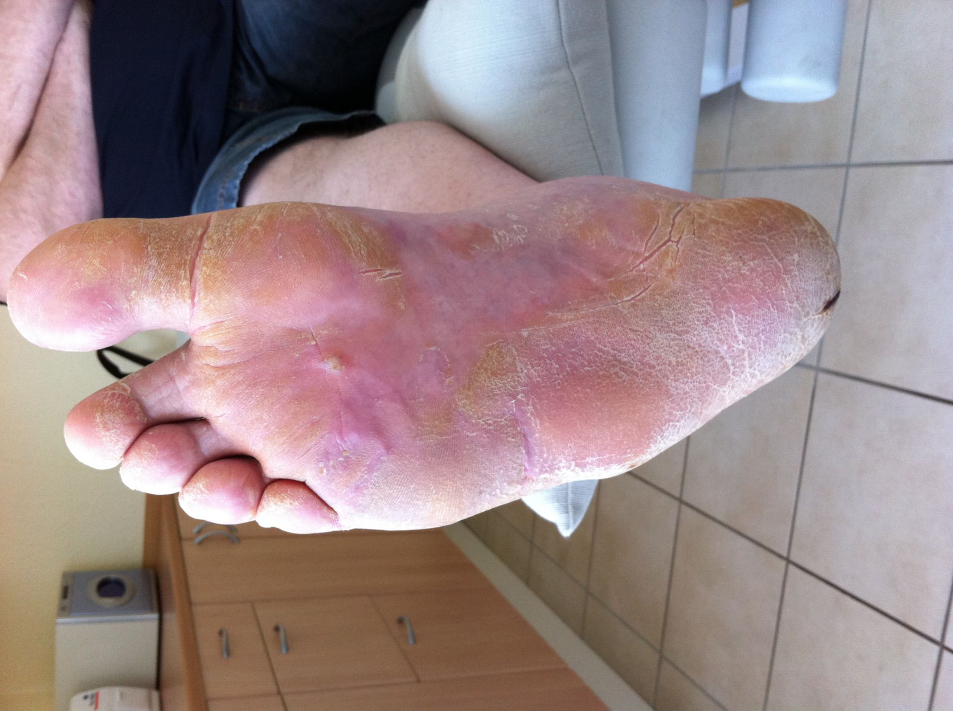 Plantar hyperkeratosis