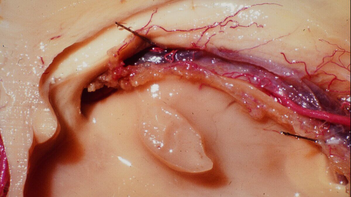 Adhaesio interthalamica