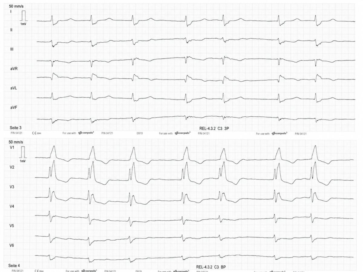EKG bei Lungenembolie