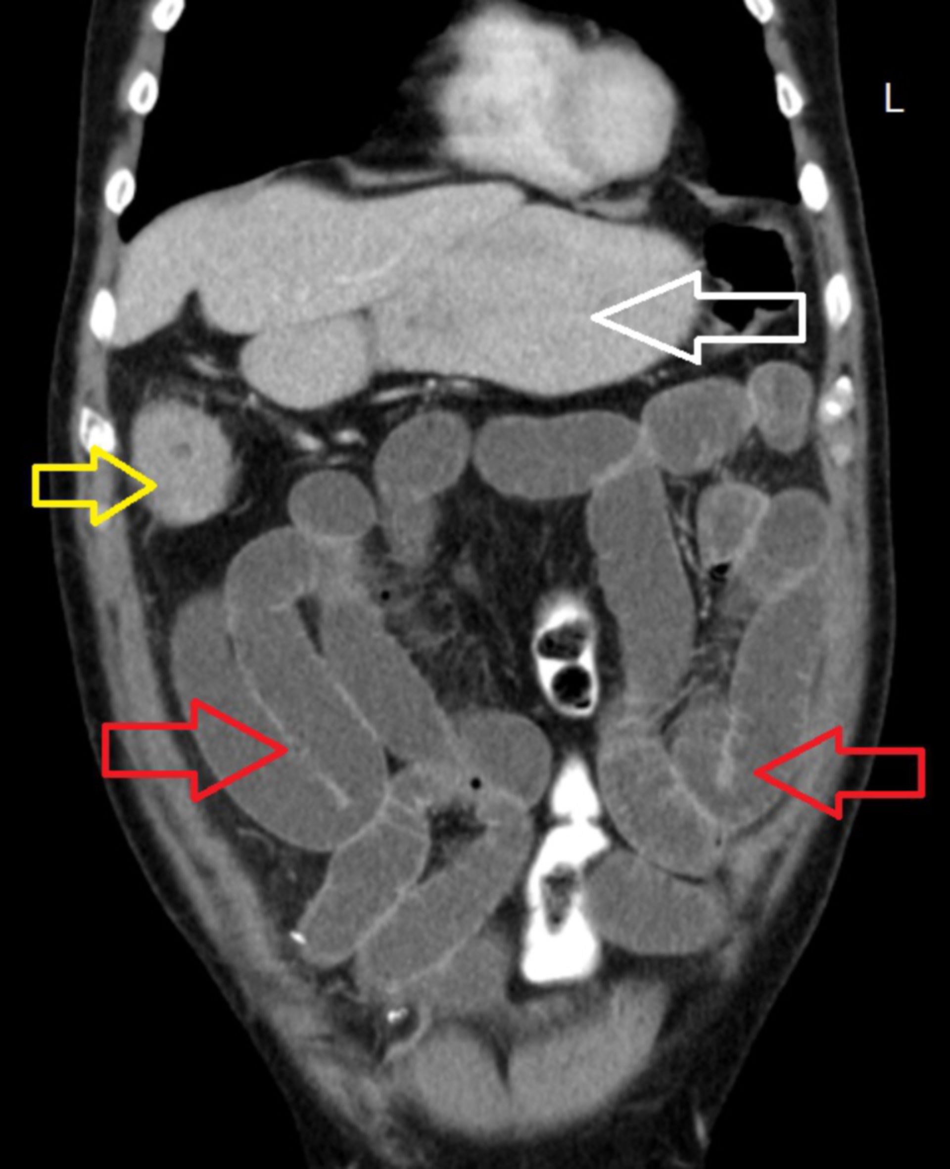 cor3: CT des Abdomens in frontaler Ebene