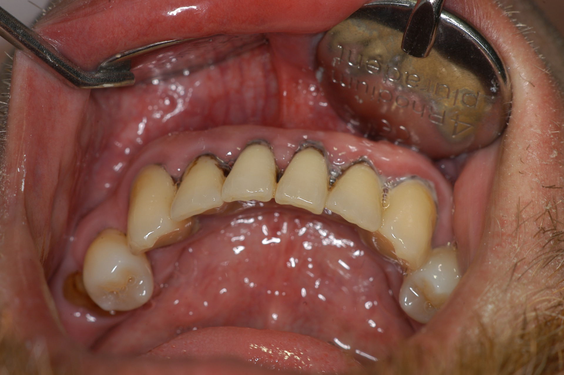 Parodontitis