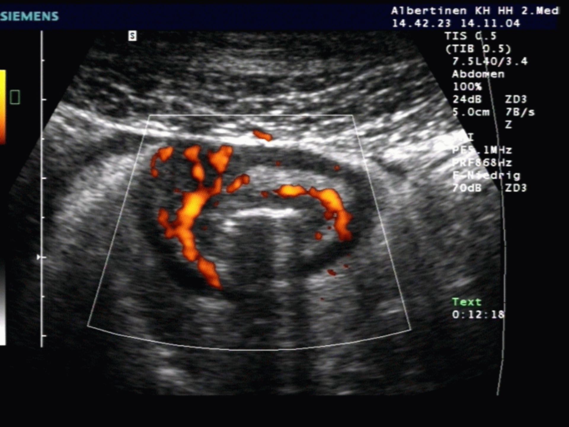 Crohn's Disease Ultrasound