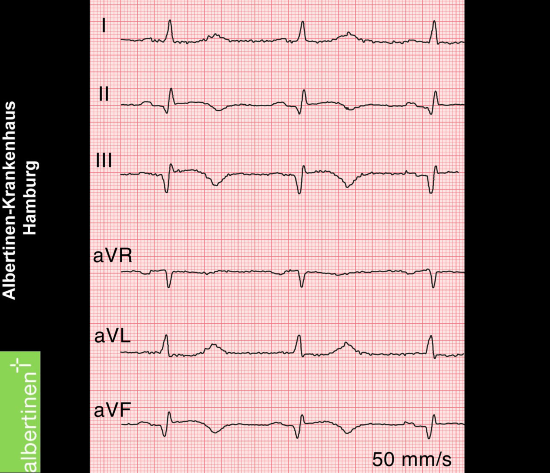 Myocardial infarction of the posterior wall: stage 2 (ECG)
