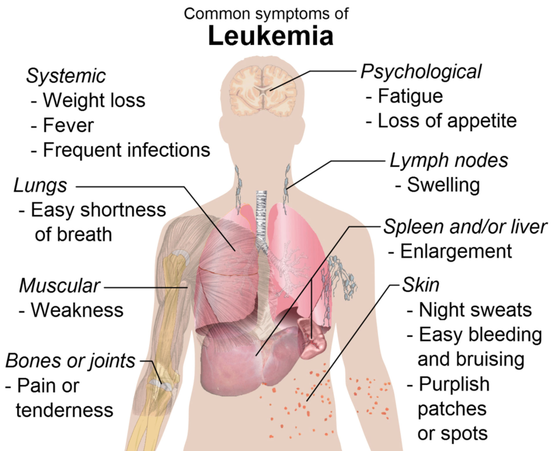 Symptome bei Leukämie