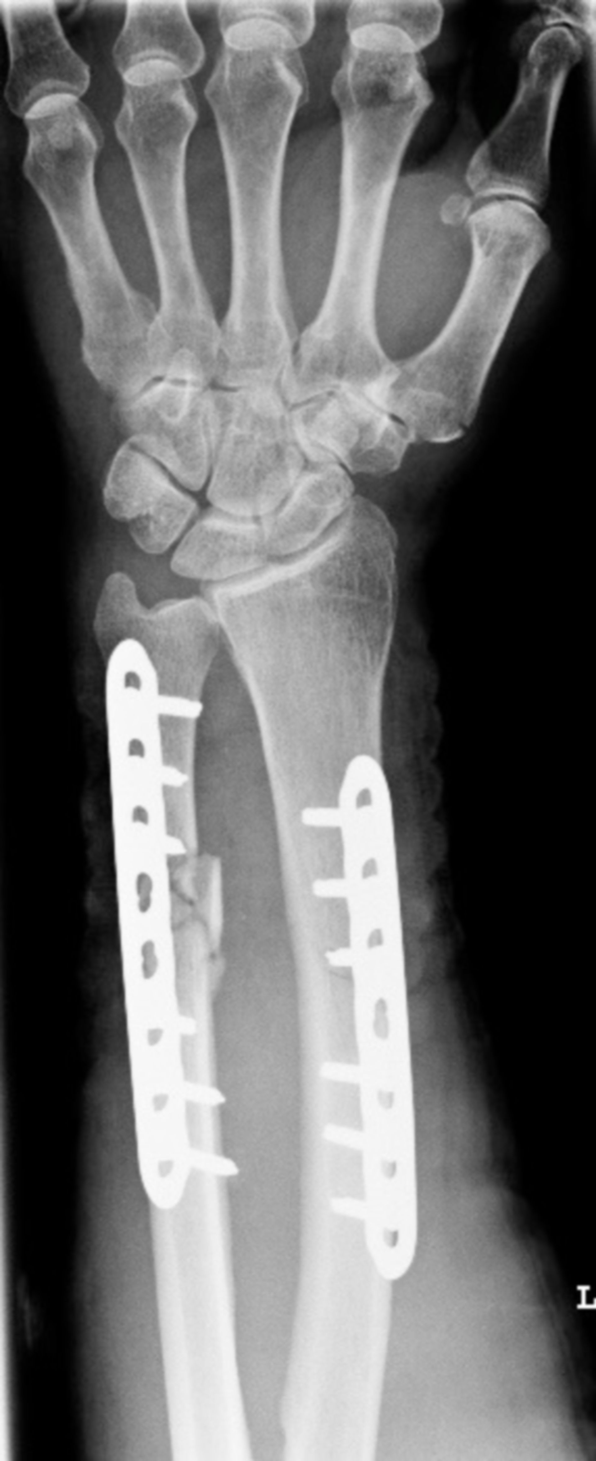 Röntgen des distalen Unterarmes nach osteosynthetischer Versorgung einer kompletten Unterarmfraktur
