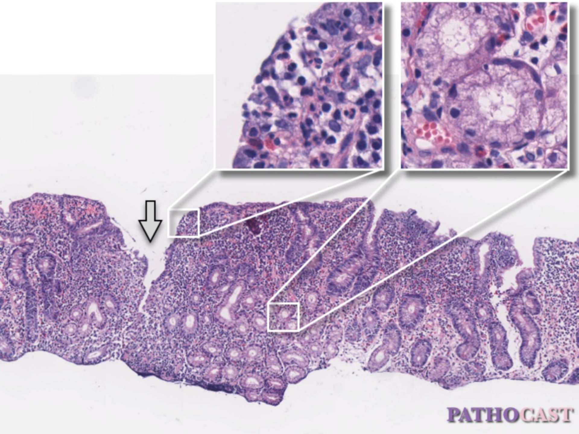 Jejunitis bei Morbus Crohn