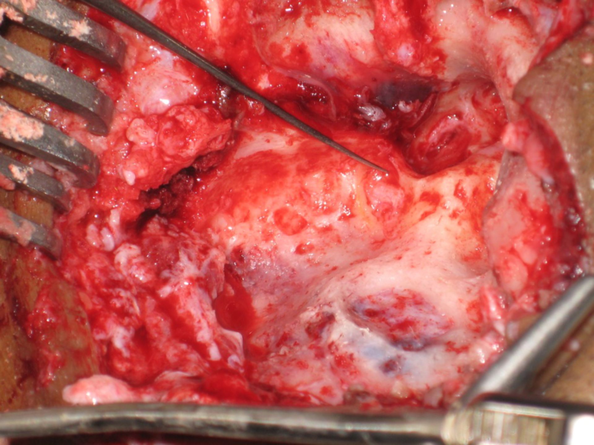 Colesteatoma gigante (3)