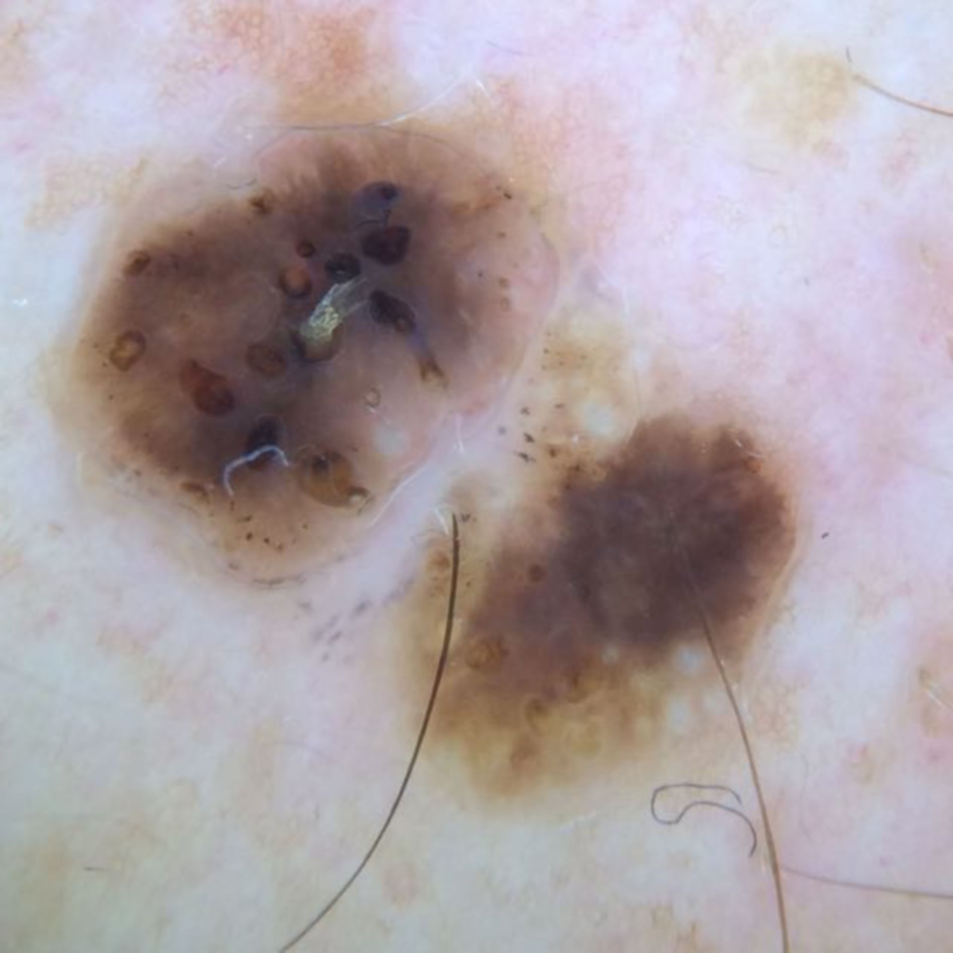 Seborrhoeic keratosis with Dermalite and iPhone 5s
