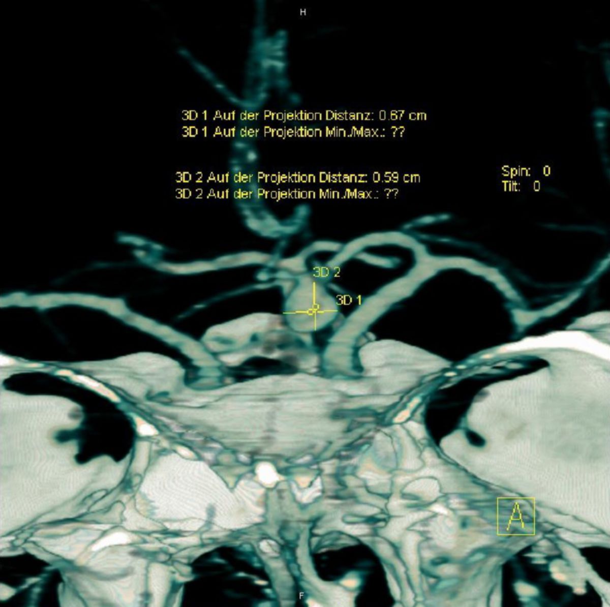 Aneurysma - CT-Angiographie, Messung