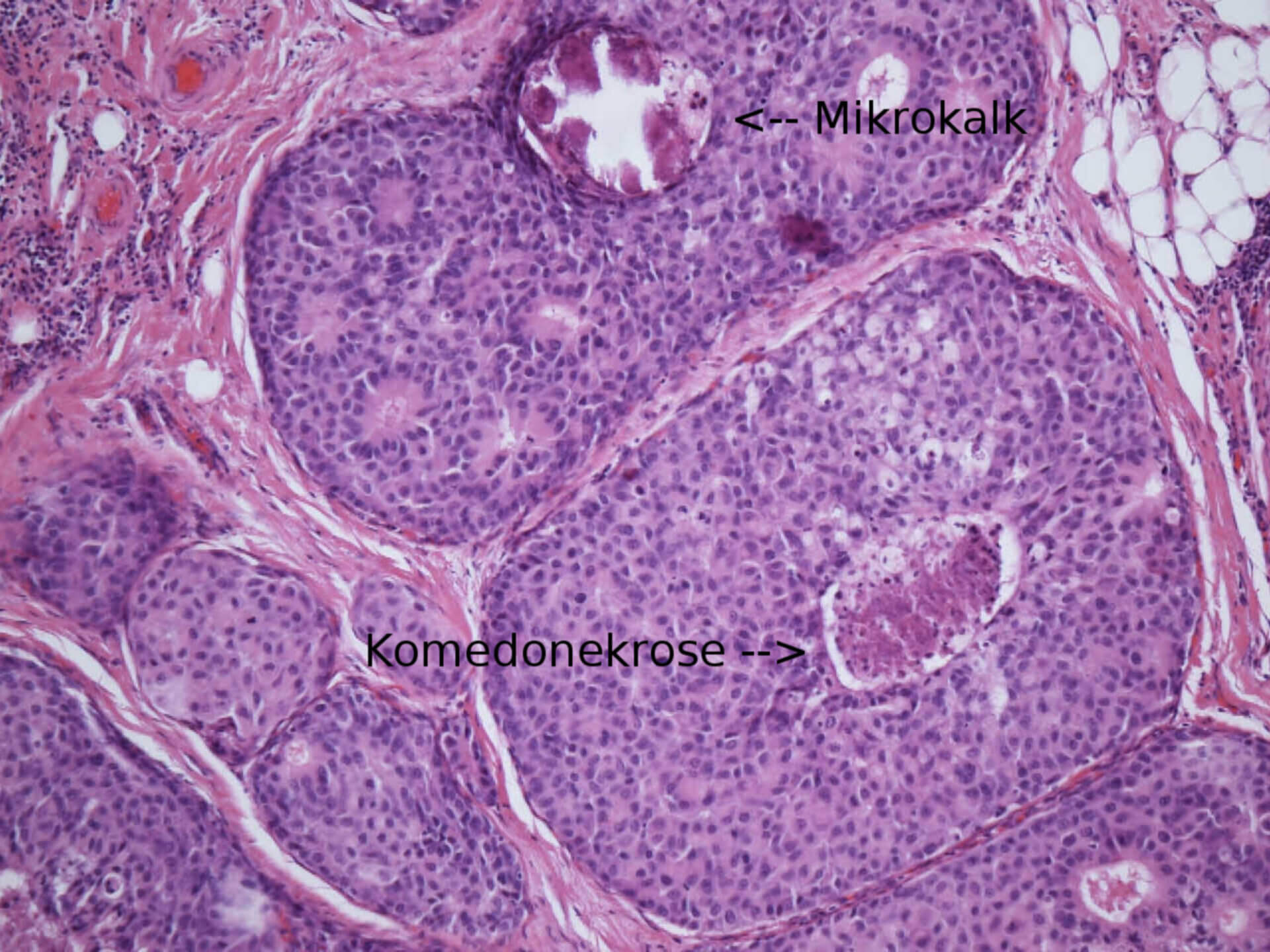 Duktales Carcinoma in situ